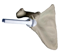 Omoplate Aston medical