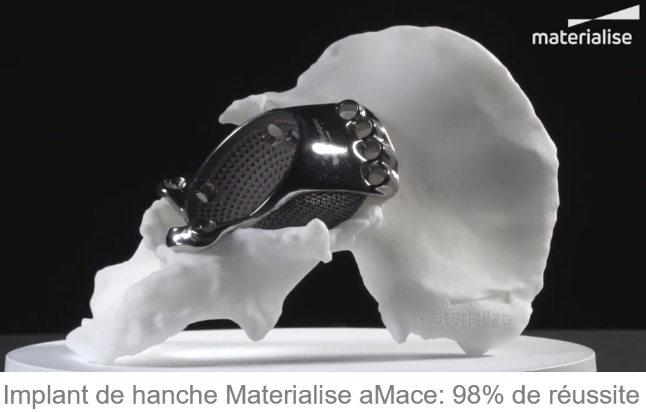 Implant de hanche Materialise aMace