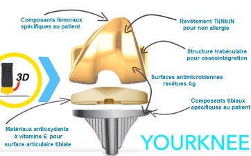 Prothèse totale de genou combinant l’intelligence artificielle et la fabrication additive (Rejoint, IT)